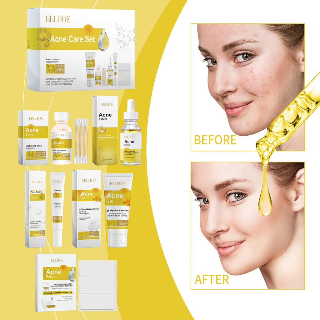 EELHOE Acne Skin Care Set for Moisturizing and Enhancing Soft Skin for Acne Skin
