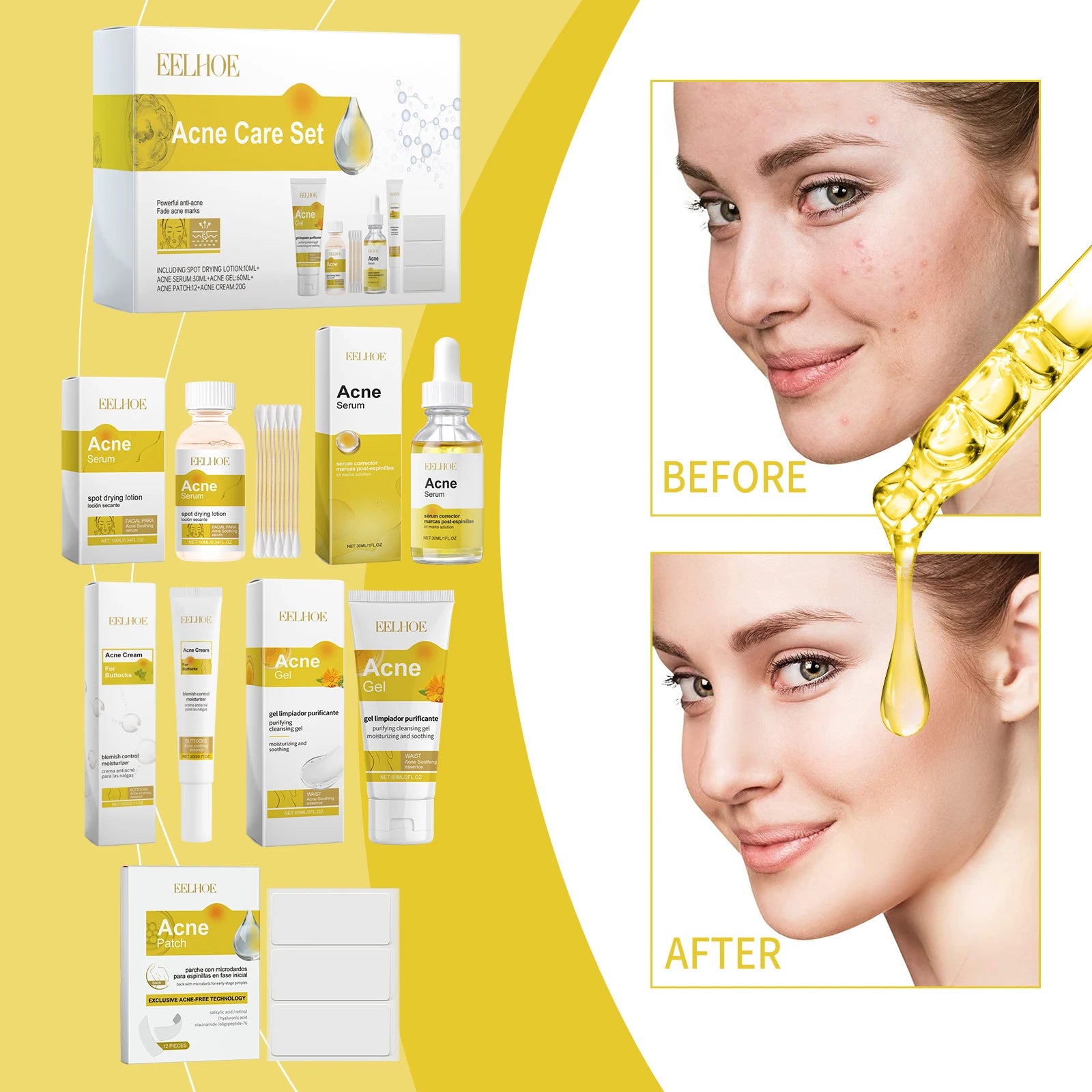 EELHOE Acne Skin Care Set for Moisturizing and Enhancing Soft Skin for Acne Skin